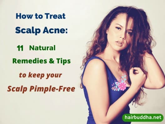 How To Treat Scalp Acne:11 Natural Remedies to Keep Your Scalp Pimple-Free