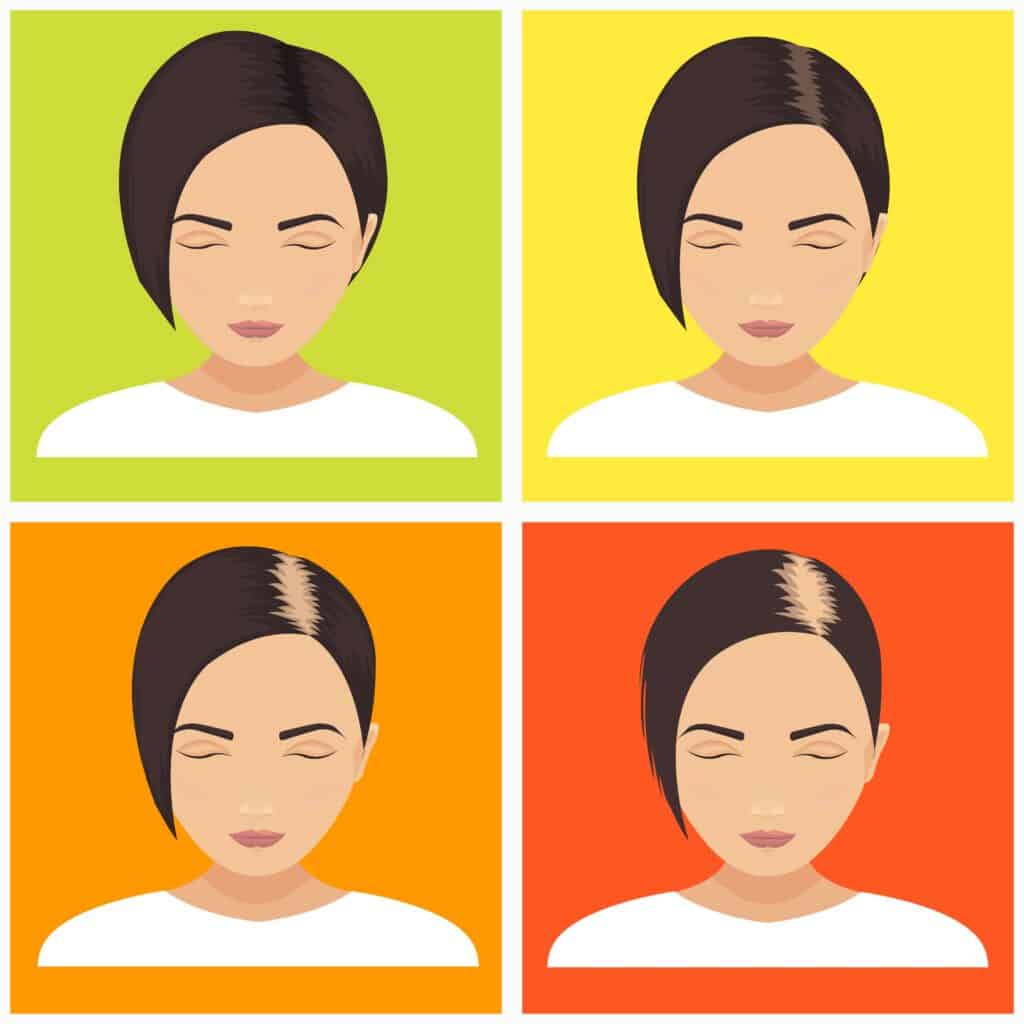 Female pattern hair loss